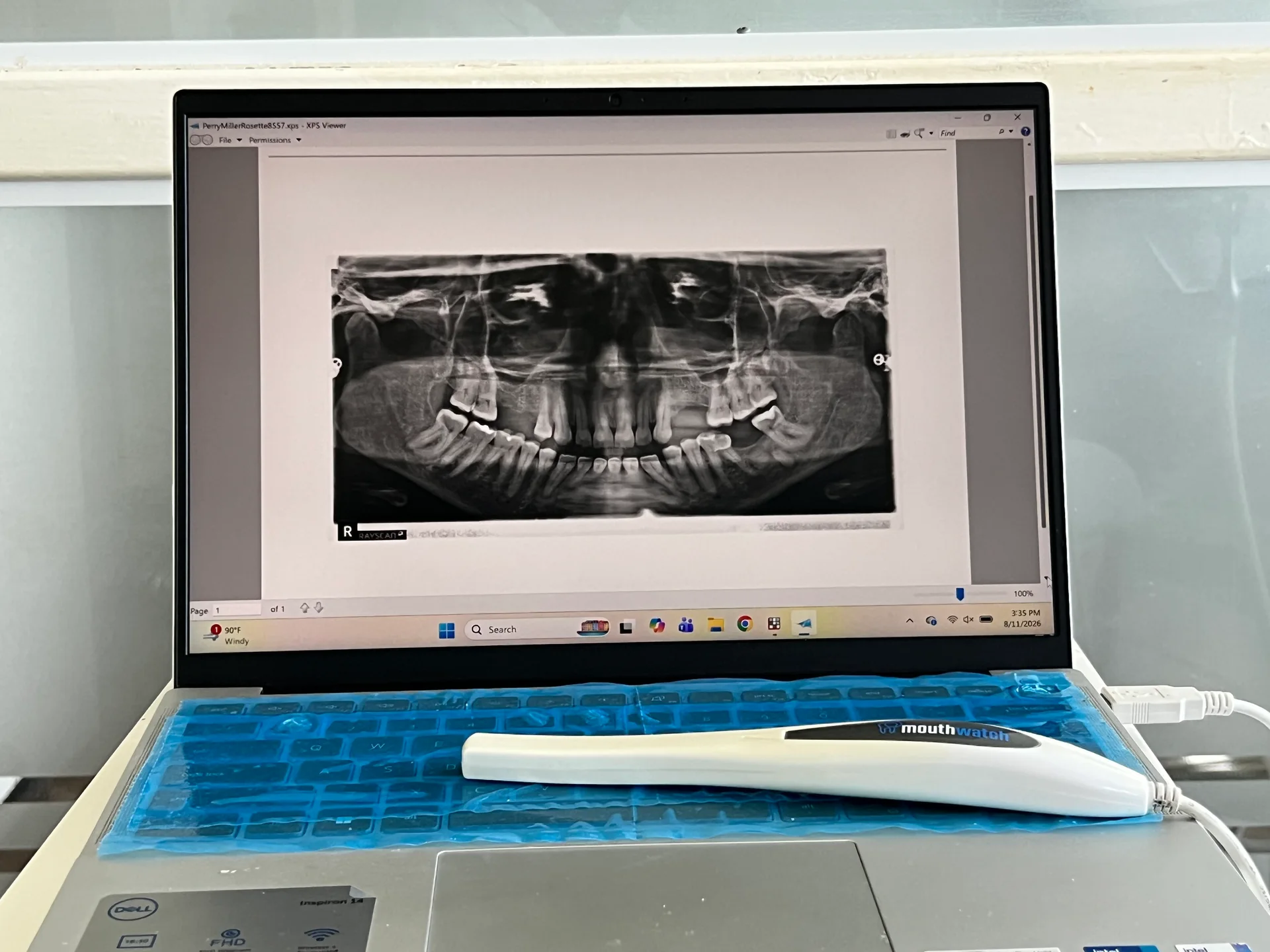 A digital panoramic dental X-ray displayed on a laptop beside an intraoral camera