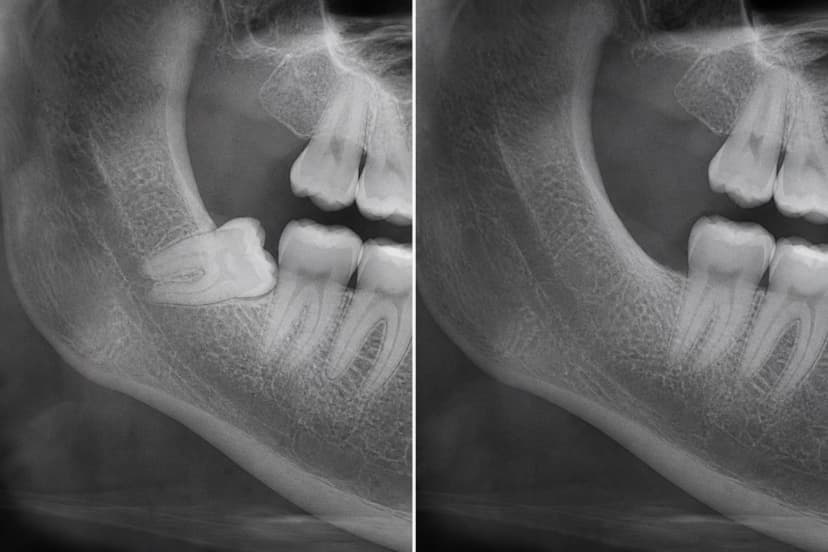 Representative paired treatment visualization for Wisdom Teeth Removal